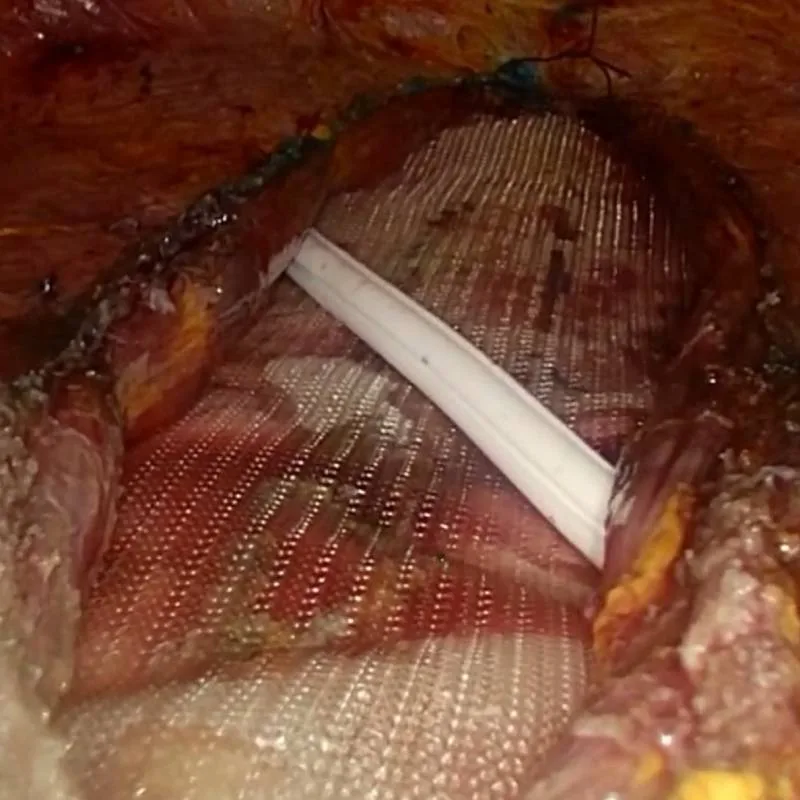 Dettaglio intraoperatorio della ricostruzione della parete addominale