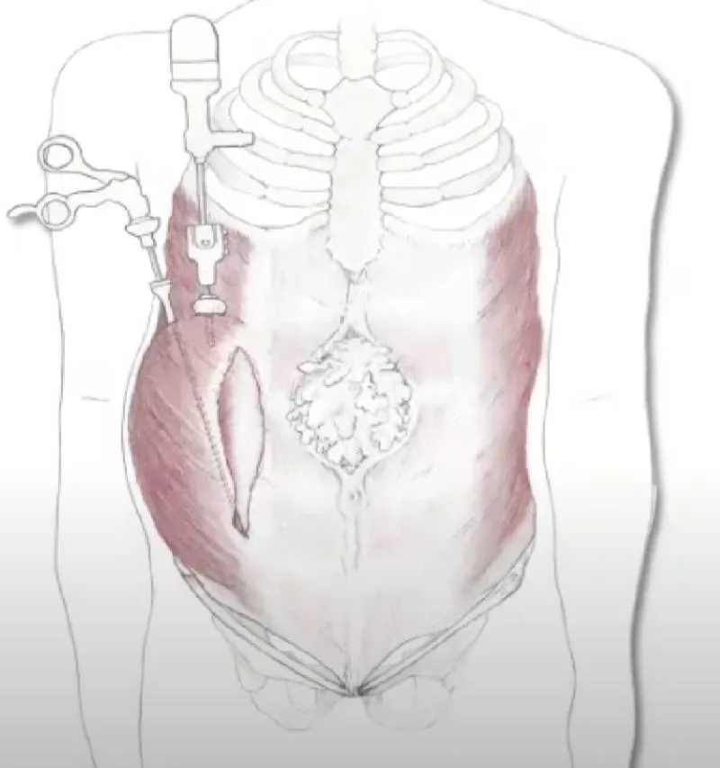 Modifica endoscopica della separazione dei componenti addominali