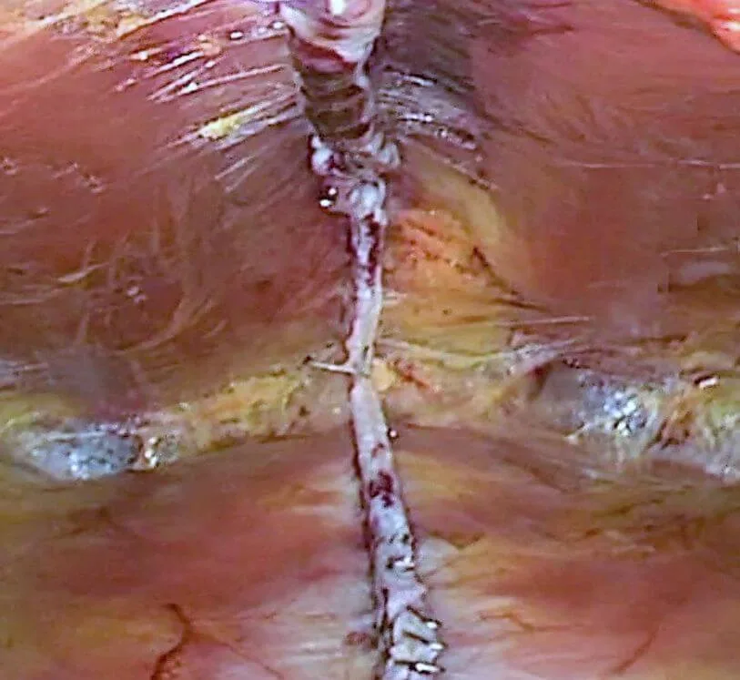 Imaging della parete addominale dopo il trattamento chirurgico
