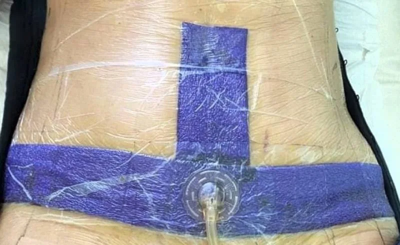 Applicazione del sistema VAC therapy per complicanze della ferita addominale