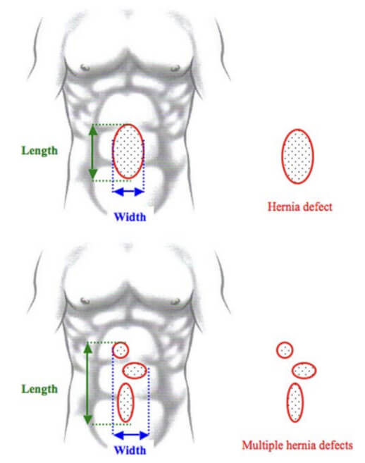 Difetti legati a ernie addominali